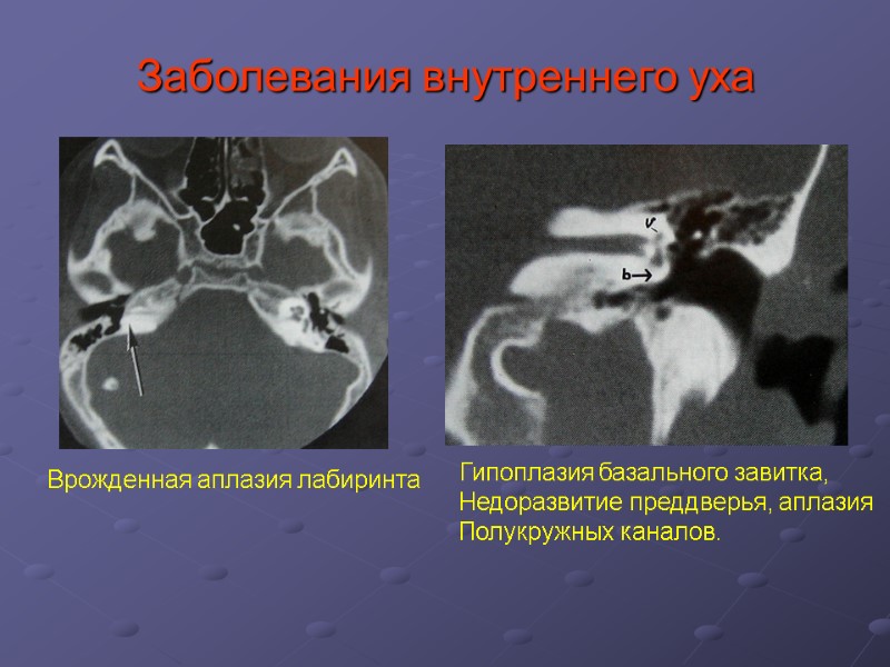 Заболевания внутреннего уха Врожденная аплазия лабиринта Гипоплазия базального завитка, Недоразвитие преддверья, аплазия Полукружных каналов.